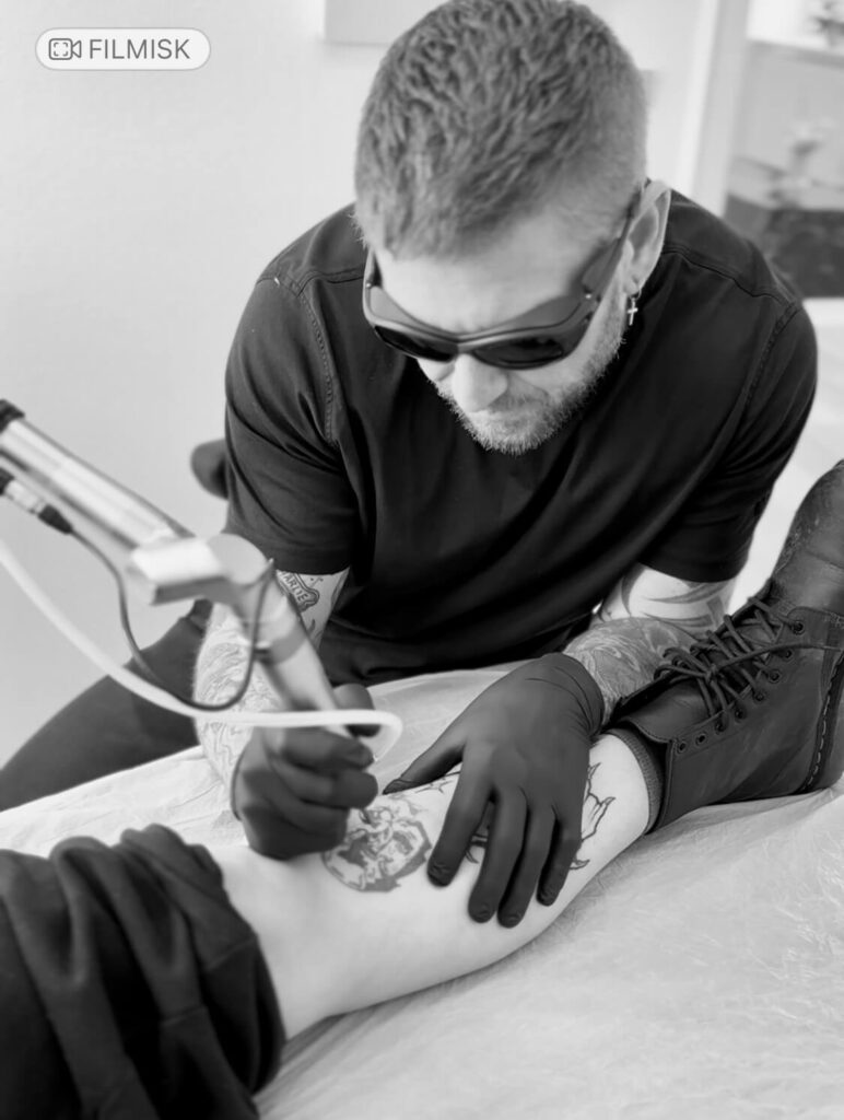 Fjernelse af tatovering - laser tattoo removal med prisgaranti1