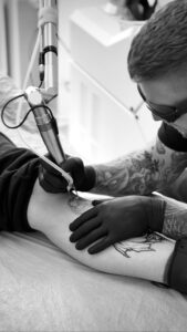 fjernelse af tatovering - tatoo laser removal2