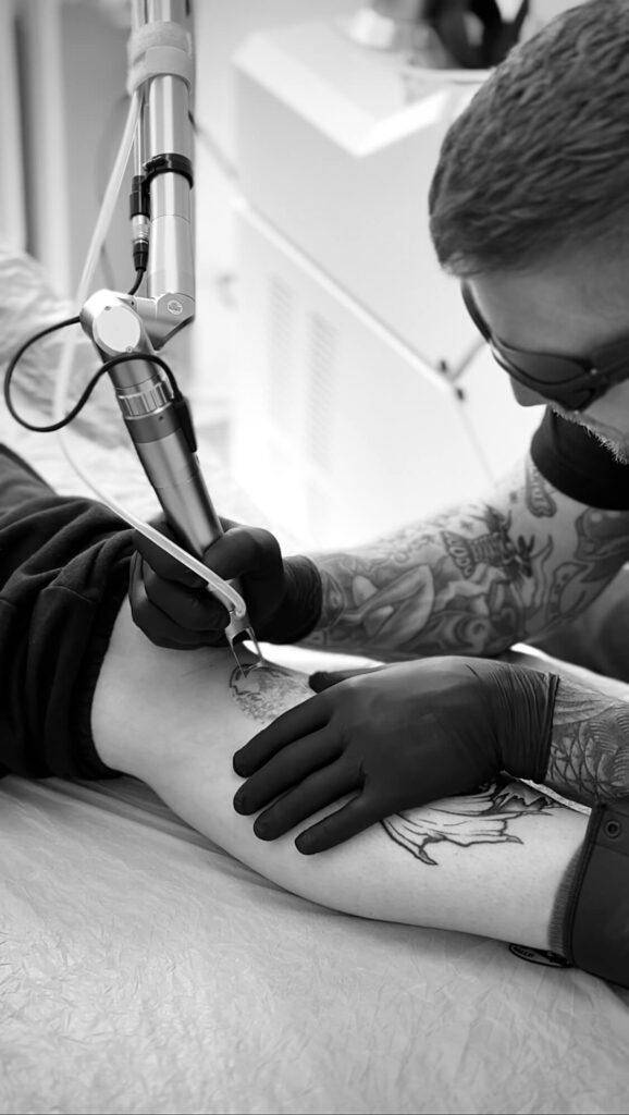 Fjernelse af tatovering - laser tattoo removal med prisgaranti3